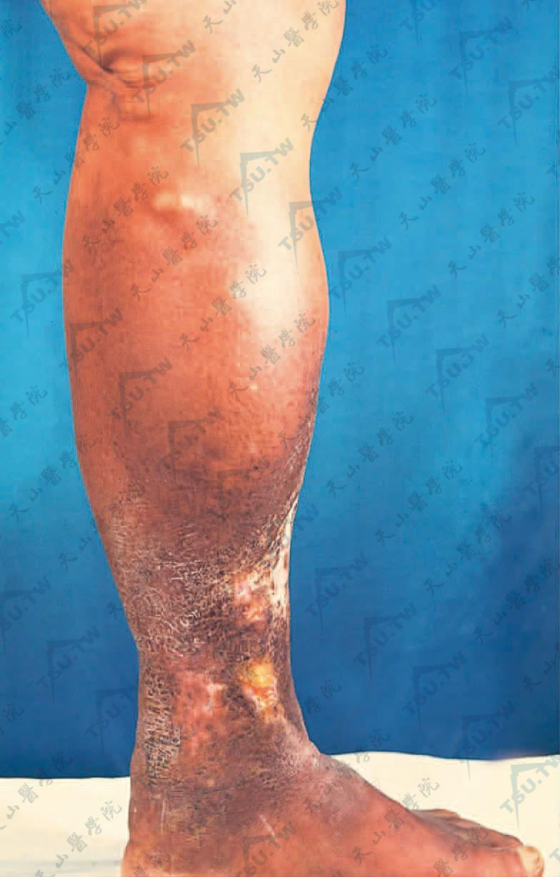 下肢静脉曲张产生淤积性皮炎，糜烂继发小溃疡，反复发生后留瘢痕、色素沉着