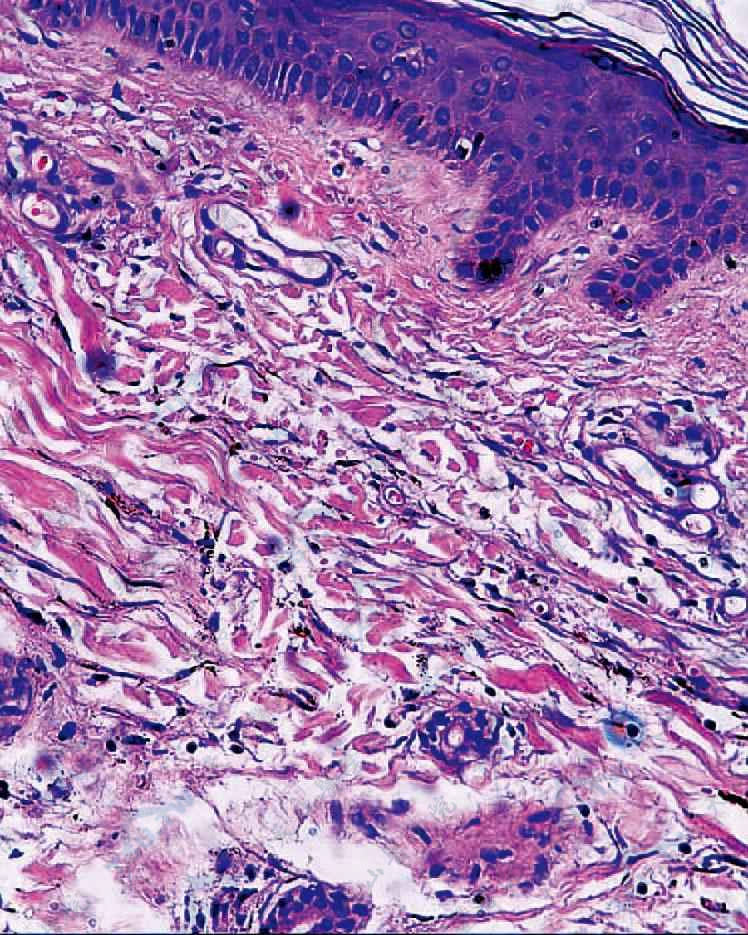 表皮色素不增加，真皮内有红细胞外渗，见多数色素颗粒