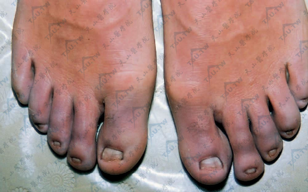 肢端青紫症症状：双足肢端苍白带青紫色，皮肤凉冷，多汗
