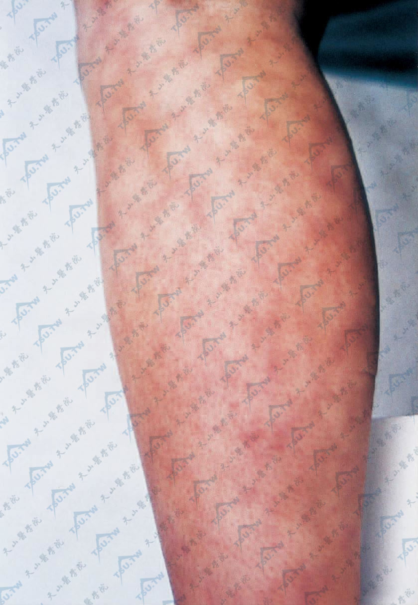 网状青斑症状：下肢青紫色网状或树枝状斑，网纹间皮肤正常或苍白