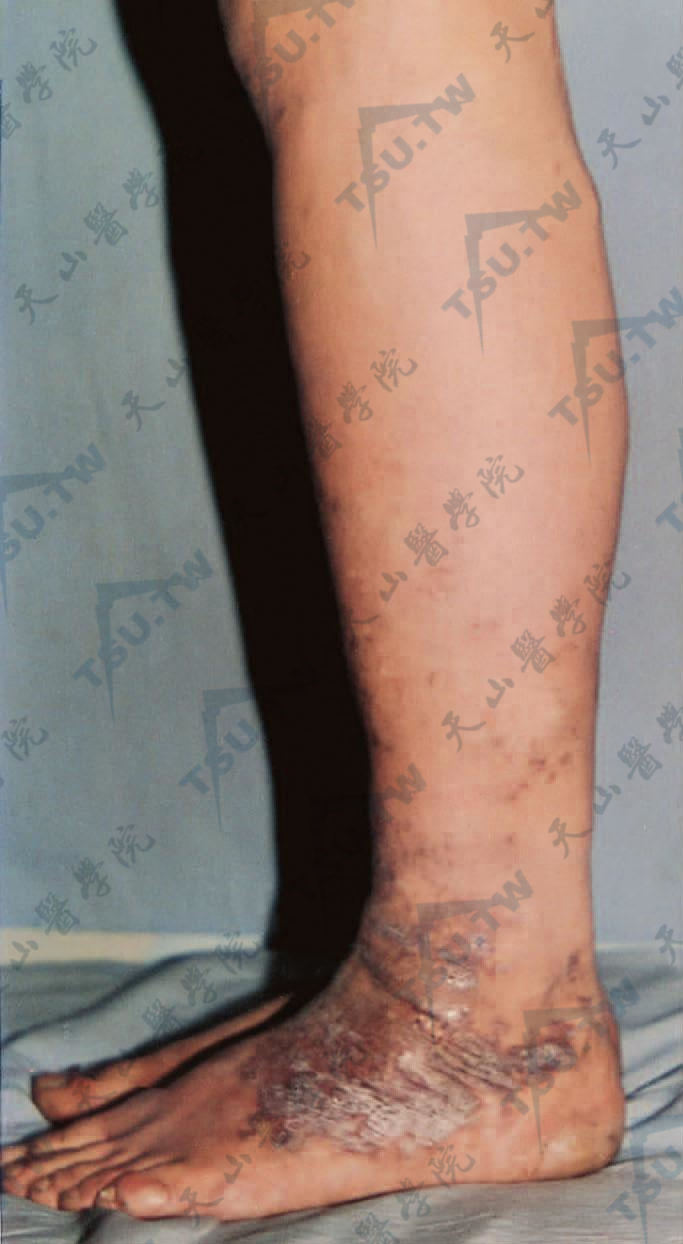 左下肢粗大、足背明显血管曲张，红斑、丘疹、结痂、浸润及苔癣样变