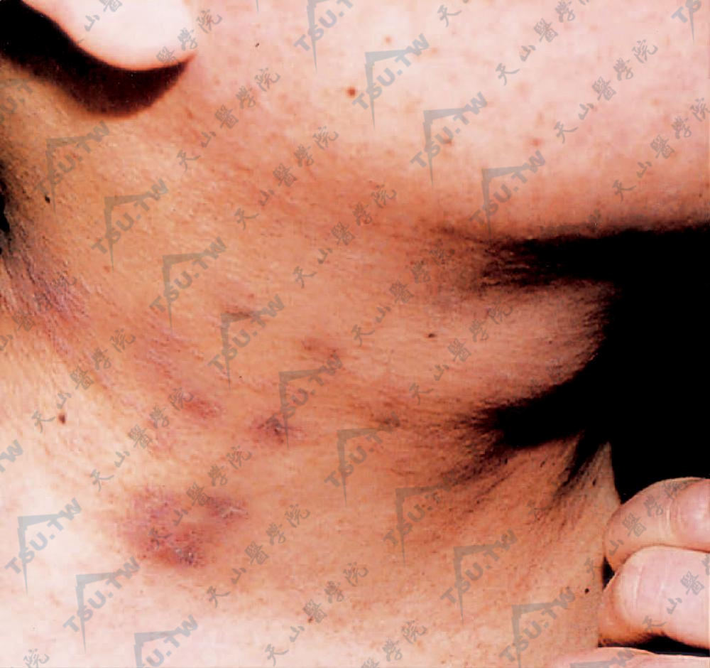 移植物抗宿主病GVHD的症状：颈部暗紫红色苔藓样丘疹，渐累及前胸、躯干、四肢