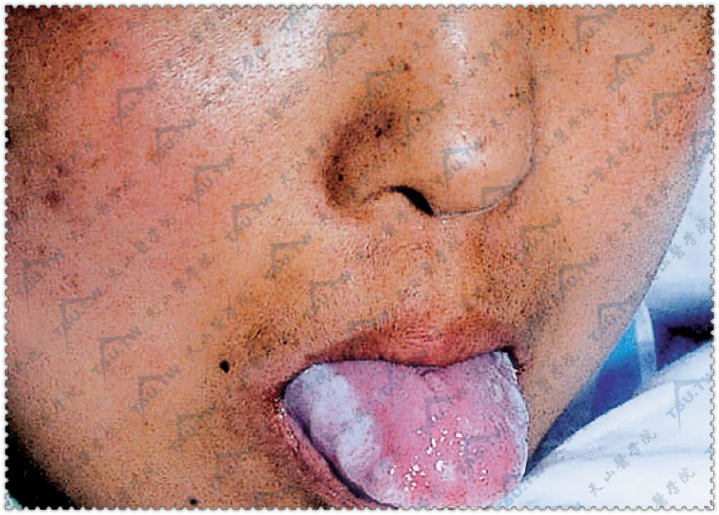急性GVHD　面部有水肿性红斑，舌黏膜变粗，舌缘白斑