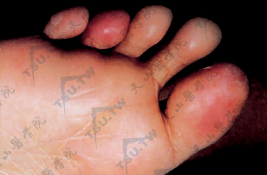 移植物抗宿主病GVHD的症状：足趾及跖部水肿性红斑