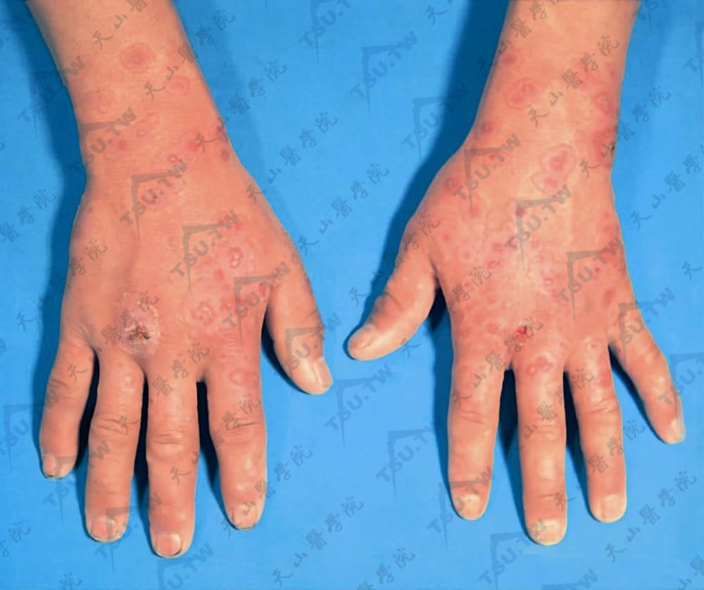 多形红斑症状：手背、前臂、水肿性红斑，边缘部呈暗红色，中央有水疱或紫癜，即所谓靶样损害
