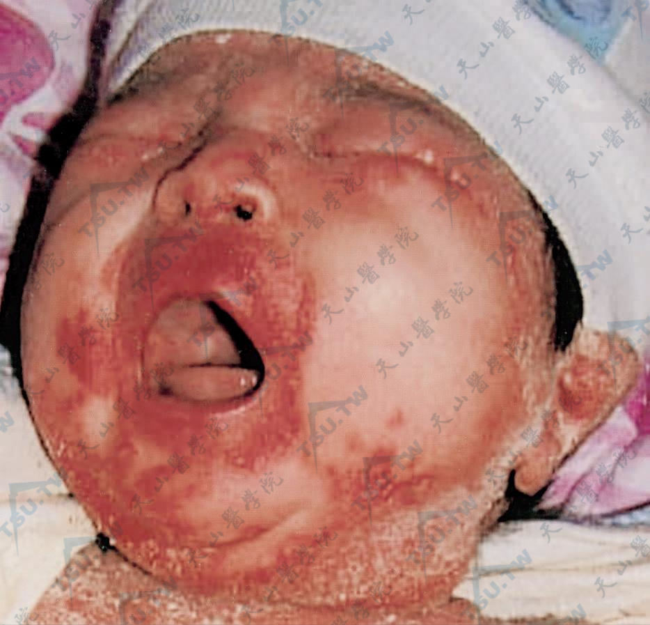 婴儿落屑性红皮病症状图
