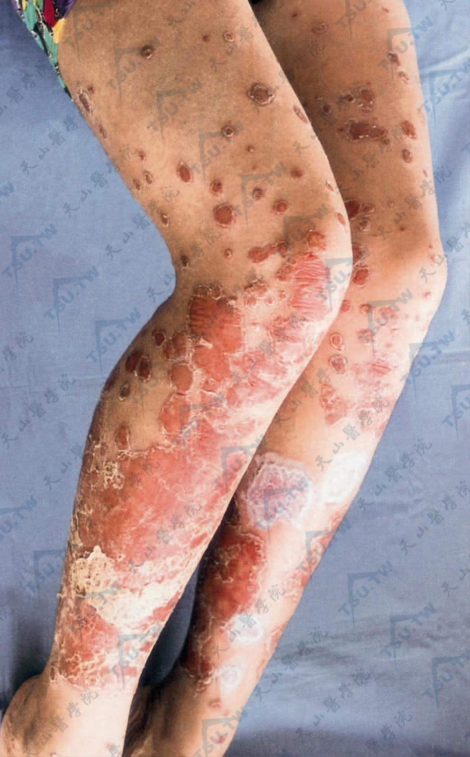 大腿银屑病：小腿部大片鲜红色斑及散在钱币状皮损，外观鳞屑并不明显