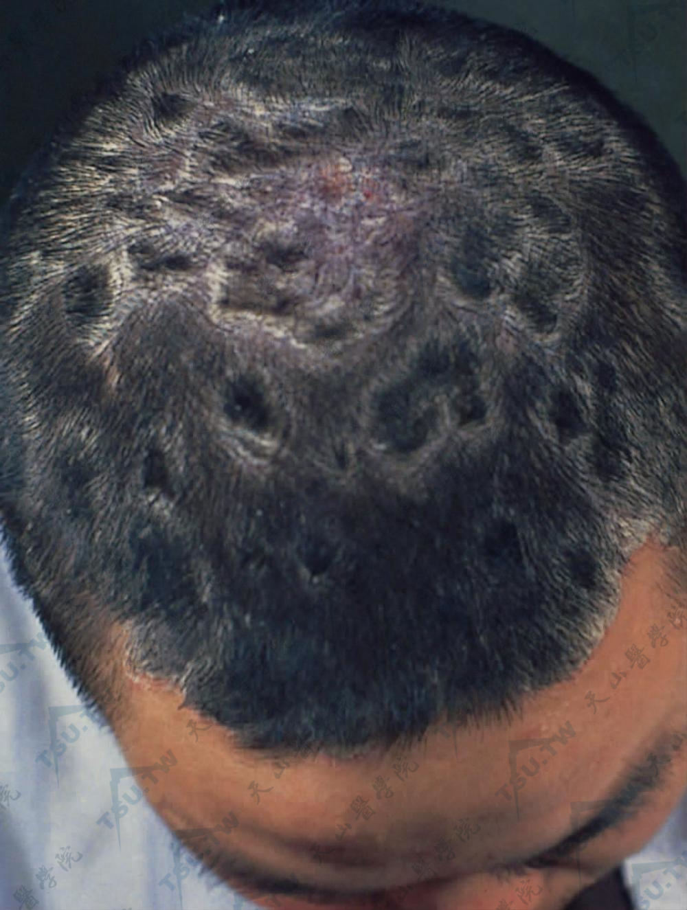 头皮银屑病：头部发内多数边界清楚、附着有厚鳞屑的红斑有的融合成片。