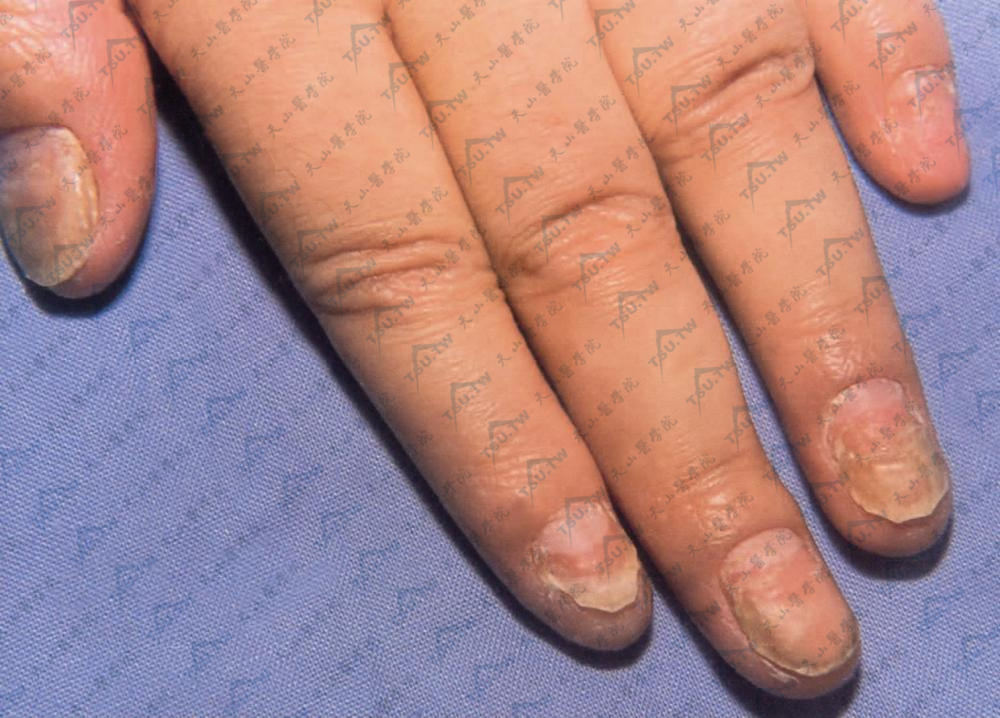 银屑病指甲图片 初期图片