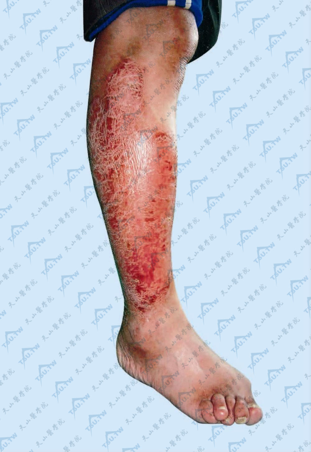 关节病型银屑病：小腿有斑块状大片银屑病皮损，足趾关节肿胀，变形