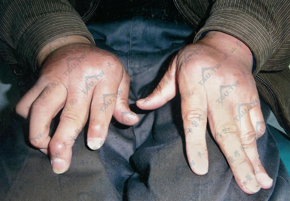 关节病型银屑病：两手指关节肿胀、变形、弯曲