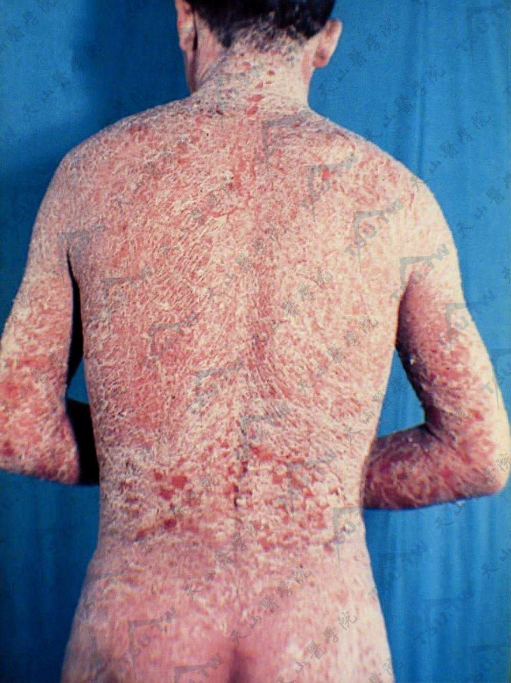 红皮病型银屑病：全身皮肤呈弥漫性红色或暗红色，表面附有大量麸皮样鳞屑