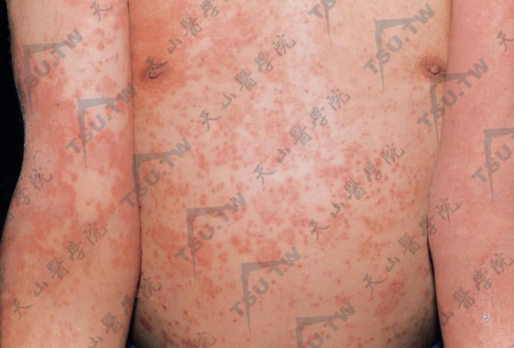 丘疹型玫瑰糠疹躯干部见多数丘疹及圆形或椭圆形斑