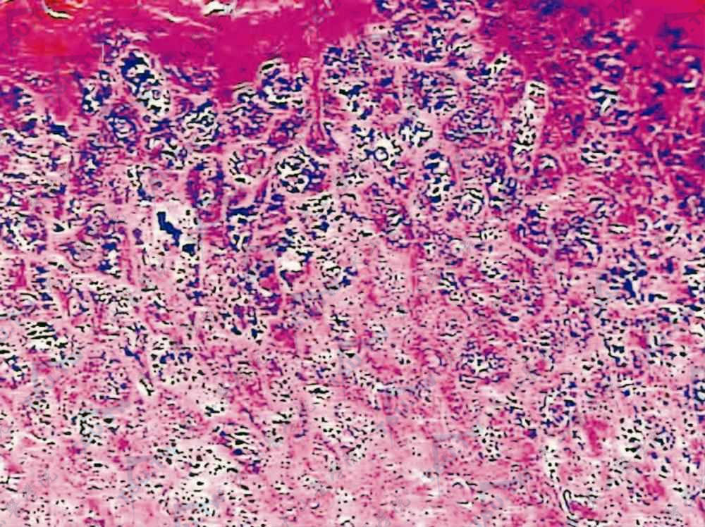 表皮松解性掌跖角皮症组织病理