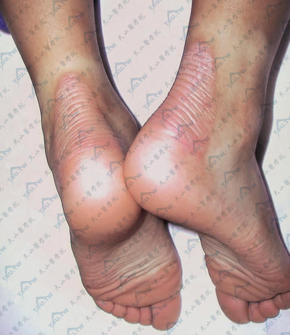 进行性对称性红斑角皮症后腿跟症状