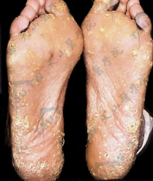 砷角化病患者症状：双足跖见多数点状角化性丘疹