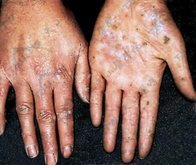 砷角化病患者症状两手掌、手背见多数点状角化性丘疹