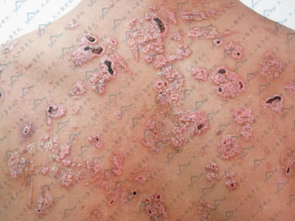 背部淡红色或正常肤色角化性丘疹排列成环状、匐行状、不规则成群分布或卫星状分布