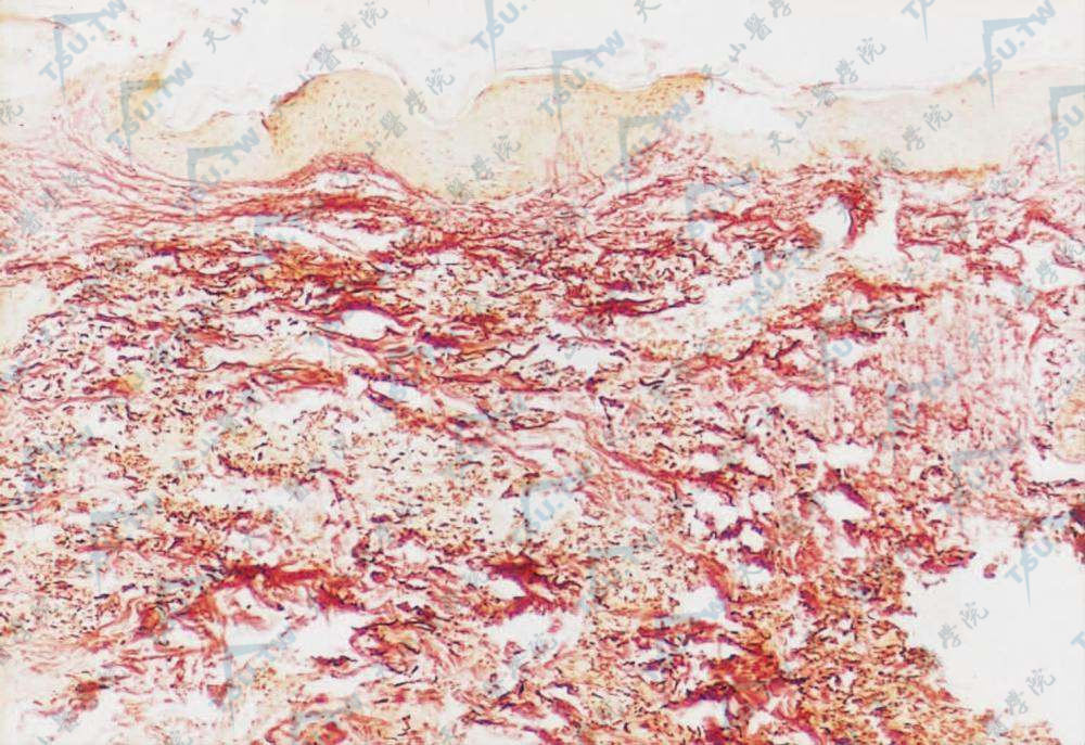 可见真皮中弹性纤维减少，并有断裂、破损呈颗粒状（地衣红染色×100）