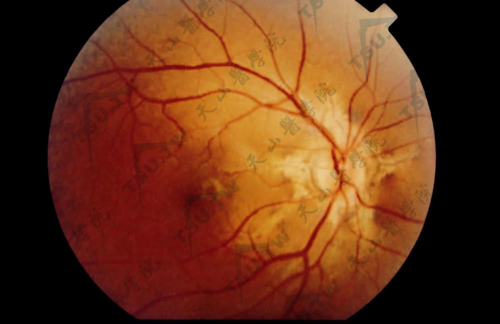 弹性纤维性假黄瘤眼部症状