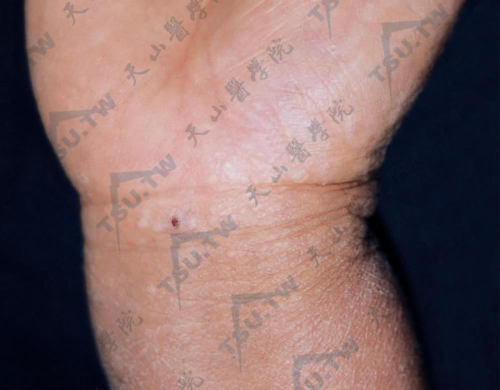腕部及拇指掌侧缘见多数小圆形角化性丘疹