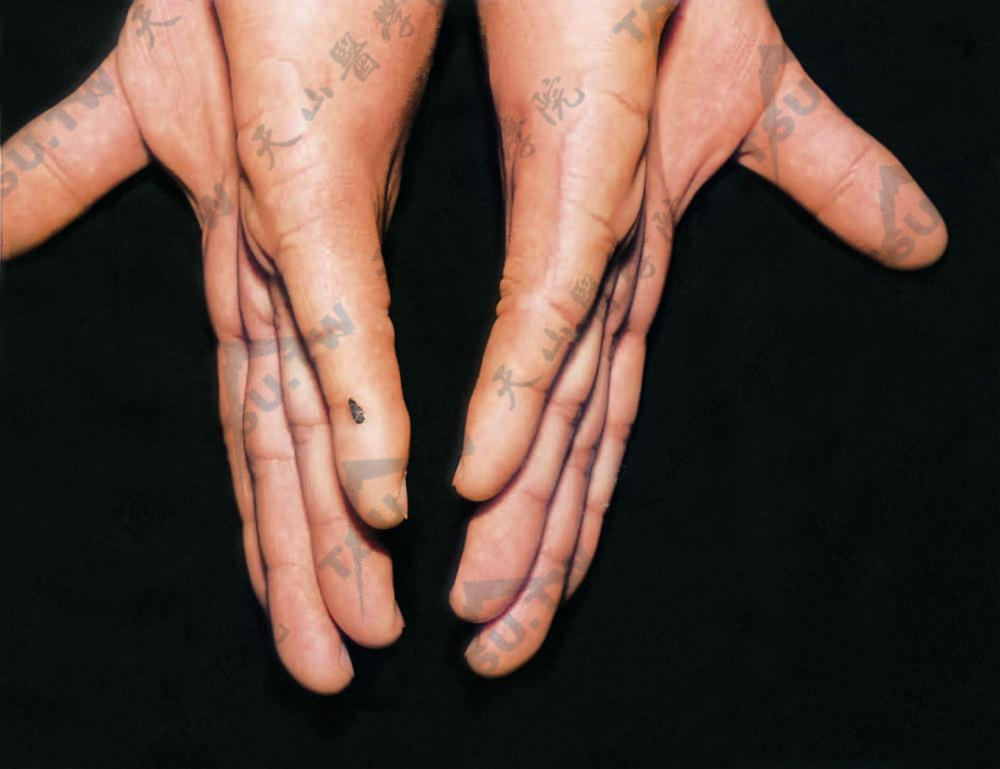 边缘性角化类弹性纤维病：手掌和背面接合部位见黄色或肉色的角化增厚性斑块