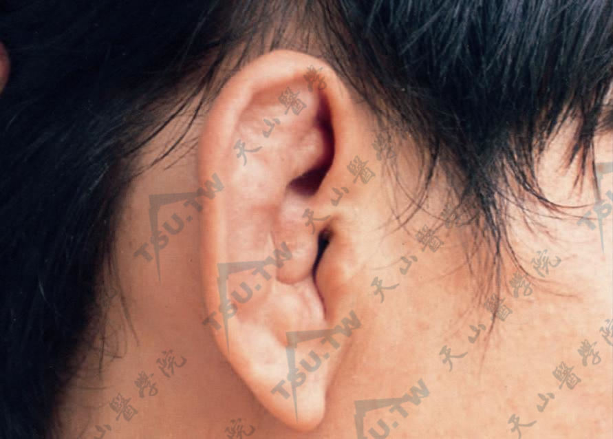 耳部弹性纤维性结节