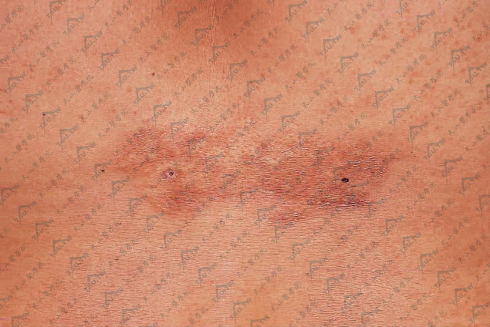 躯干部见正常皮色圆形或椭圆形丘疹成片，形成淡褐色柔软囊性斑状物