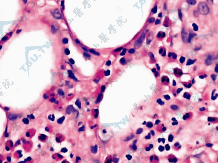 皮下脂肪组织间隔及小叶内有大量嗜酸性粒细胞及单一核细胞浸润