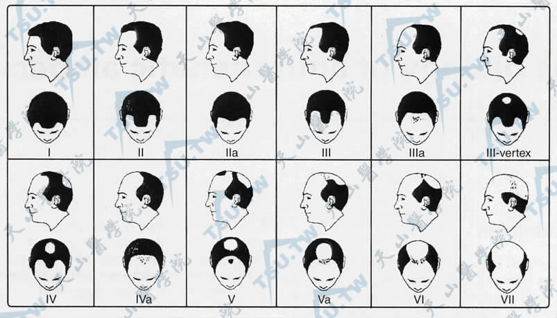 男激素性脱发的病情分级图（Hamilton）