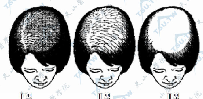 女性激素性脱发的病情分级图（Ludwig）