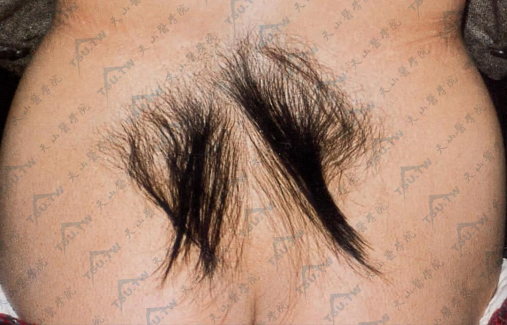 腰骶部成簇毛增长、变粗，黑色。此种局部性多毛常伴有脊柱裂