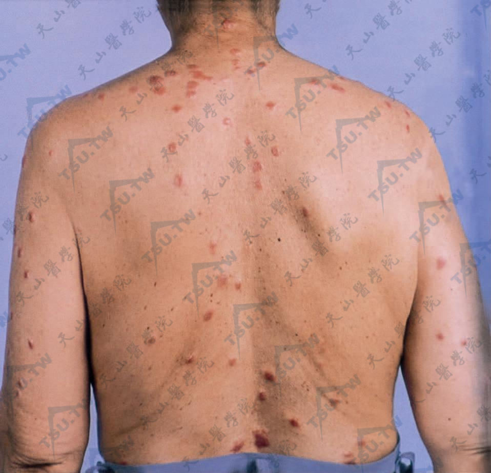 躯干、上肢分布大小不等的红色丘疹、结节