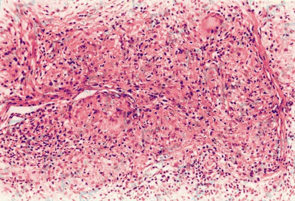 结节病组织病理：上皮样细胞团块呈鸟巢状分布，周围少量淋巴细胞和郎罕巨细胞