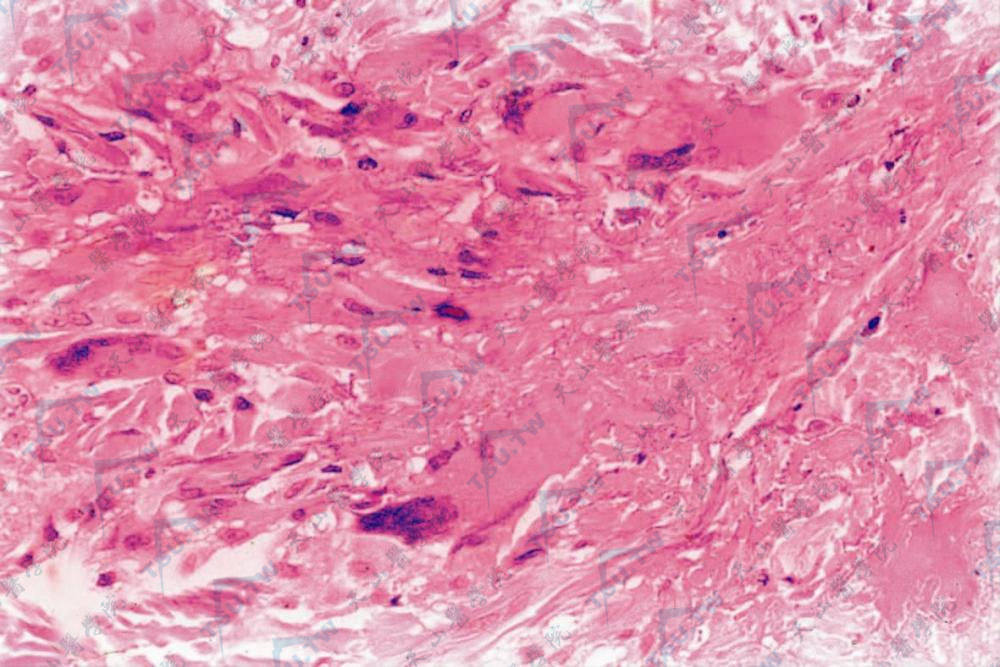 左下角为胶原完全变性灶，周围见巨细胞（HE染色×400）