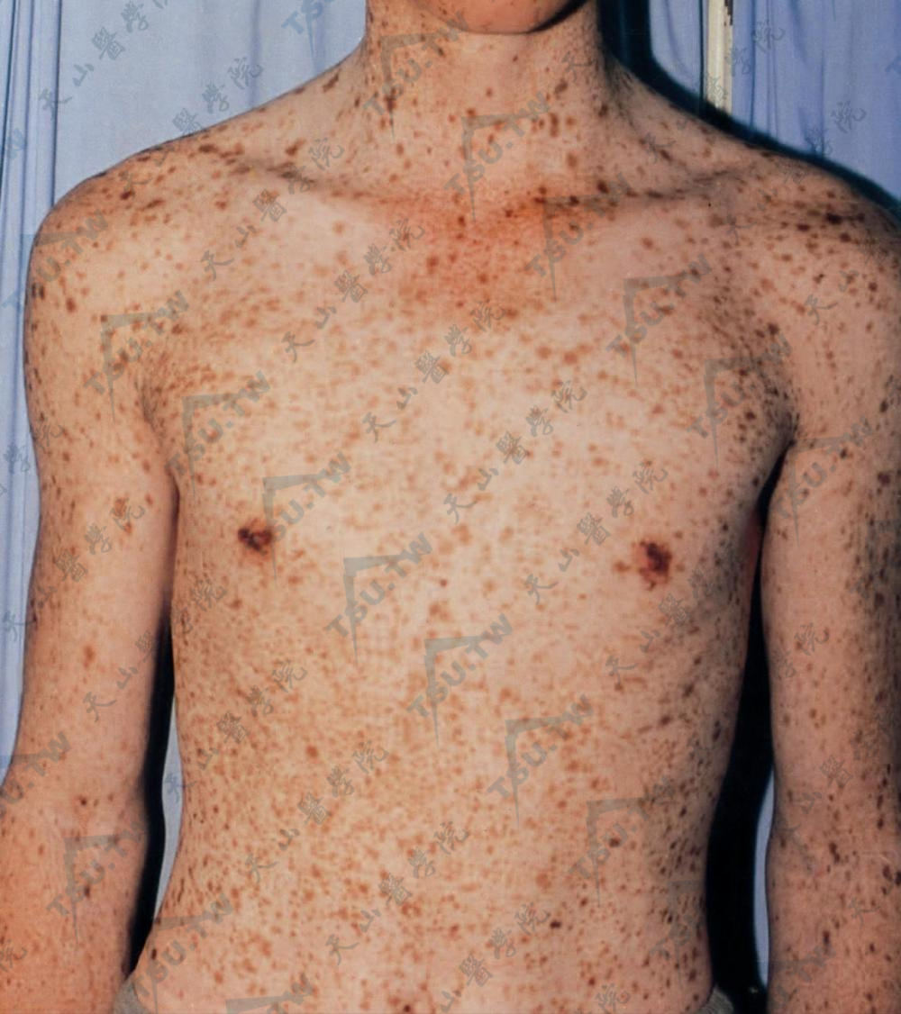 发疹性黑子病　全身泛发多数针头大至粟粒大黑褐色或褐色斑