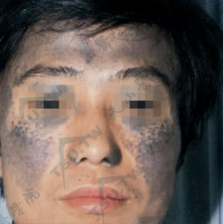 太田痣症状：面颊、上下眼睑及颈部见褐色、青灰、蓝黑色色素斑，色素可波及巩膜。此例为两侧发生