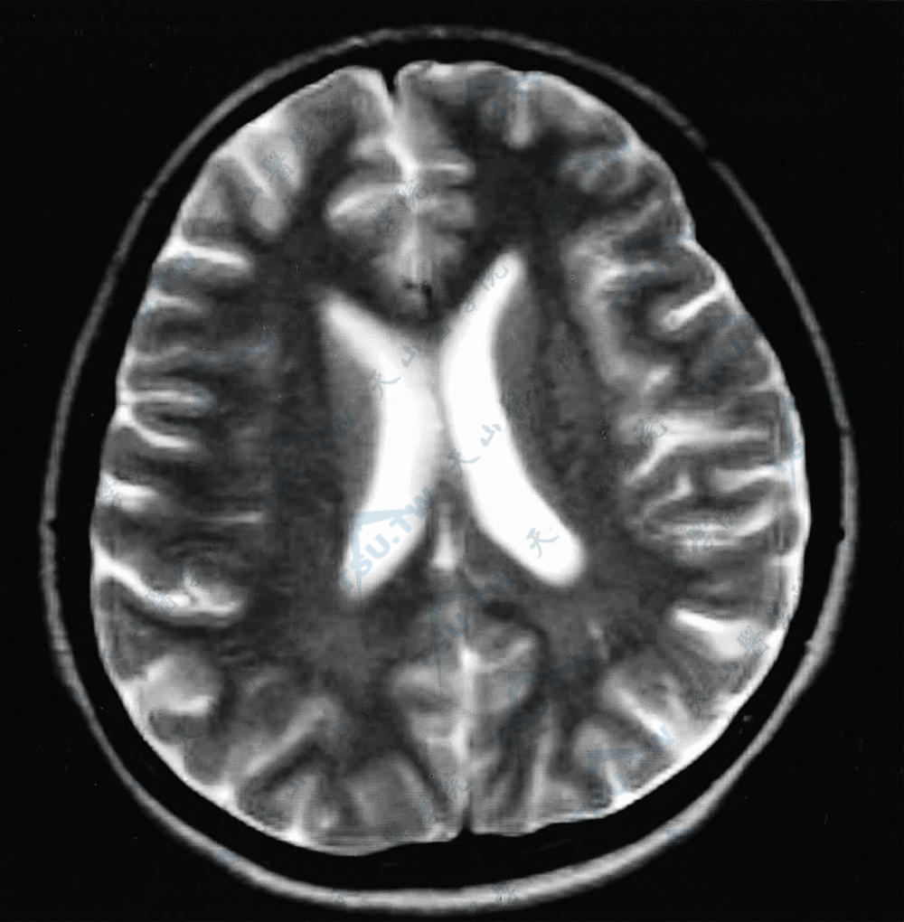 头颅MRI影像图示双侧大脑表面、脑沟内可见广泛性线条状短T1高信号影，轮廓模糊