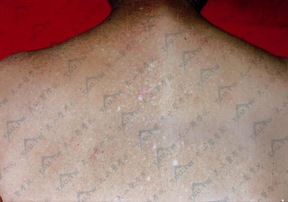 限局性色素异常症　背部色素加深伴色素减退斑，皮损呈“T”形分布