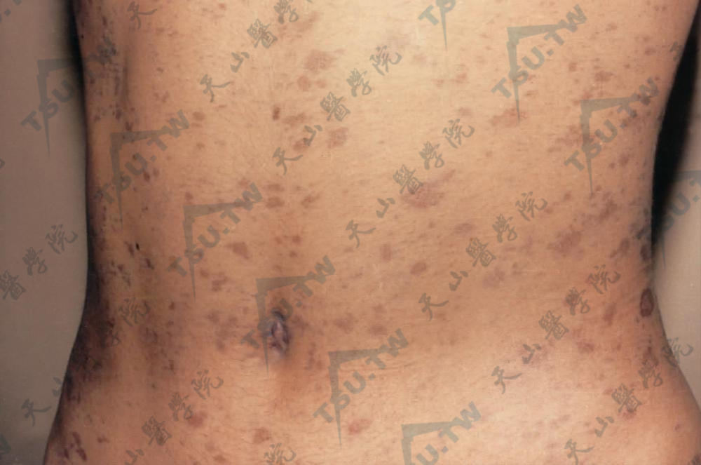 皮疹具有玫瑰糠疹特征，但皮疹颜色为青灰色、浅褐色，鳞屑少