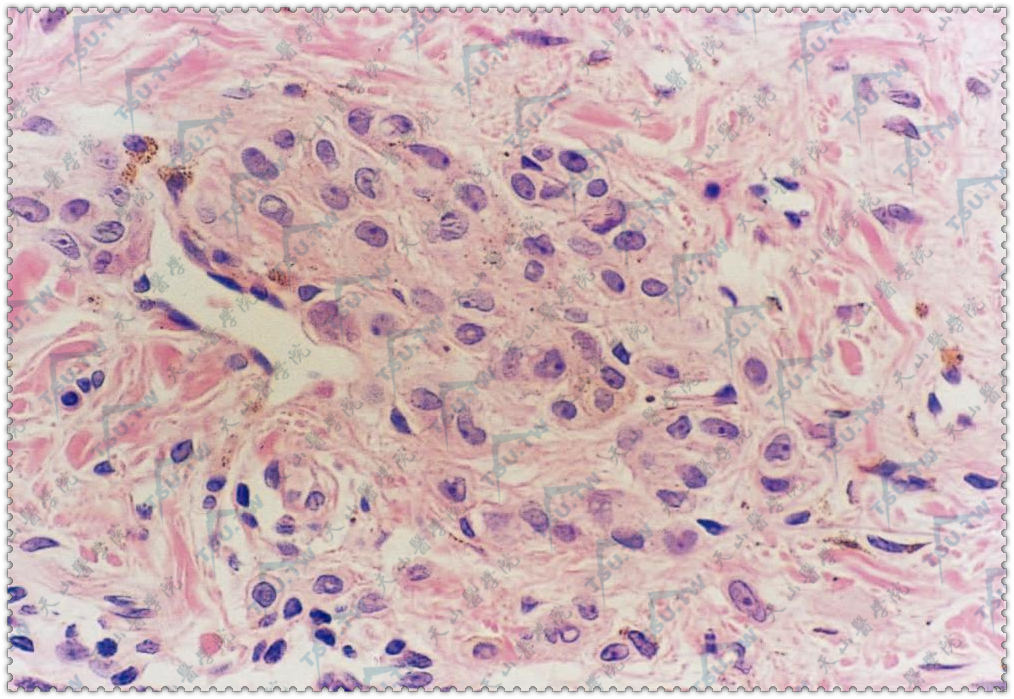 真皮浅层散在痣细胞及痣细胞巢（HE染色×400）