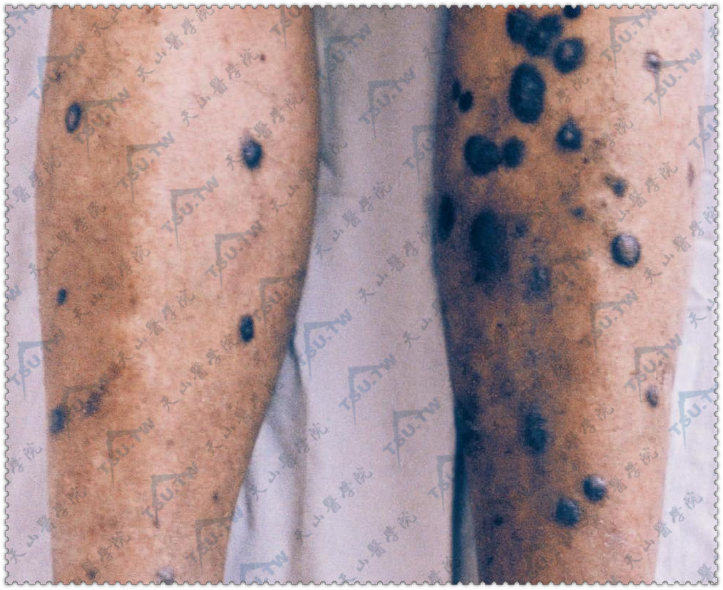 蓝痣症状：多数灰蓝色小结节，边界清楚，散在不融合，直径2～6mm。本病通常为单个损害