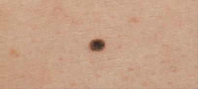 艾界症（junctional nevus）