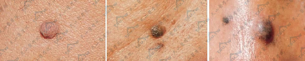 皮内痣（intradermal nevus）