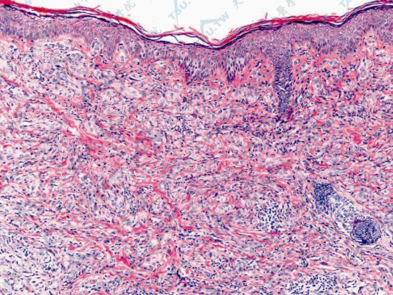 溪发性斯皮茨痣组织病理