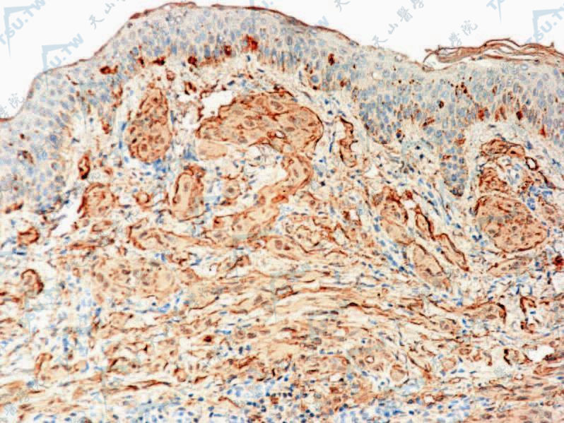 簇发性斯皮茨痣组织病理