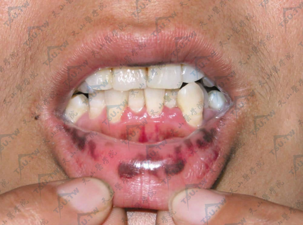 劳吉尔-亨齐克尔综合征：嘴唇色斑色素沉着症状
