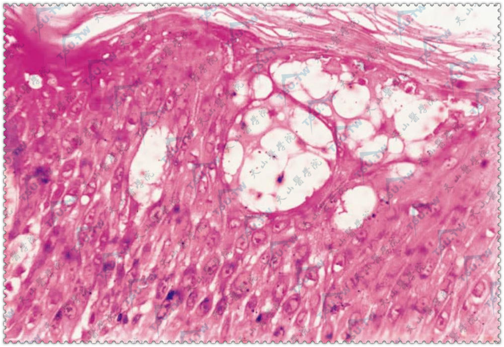 痒疹组织病理：表皮棘层肥厚，海绵形成性小疱（HE染色×400）
