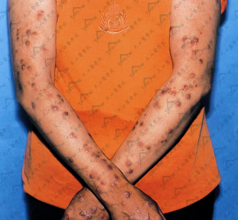 结节性痒疹的症状：上肢散在黄豆至蚕豆大小半球形结节