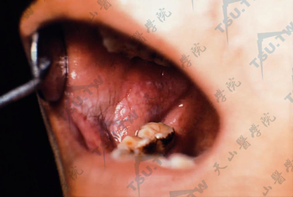 口腔黏膜白斑病症状